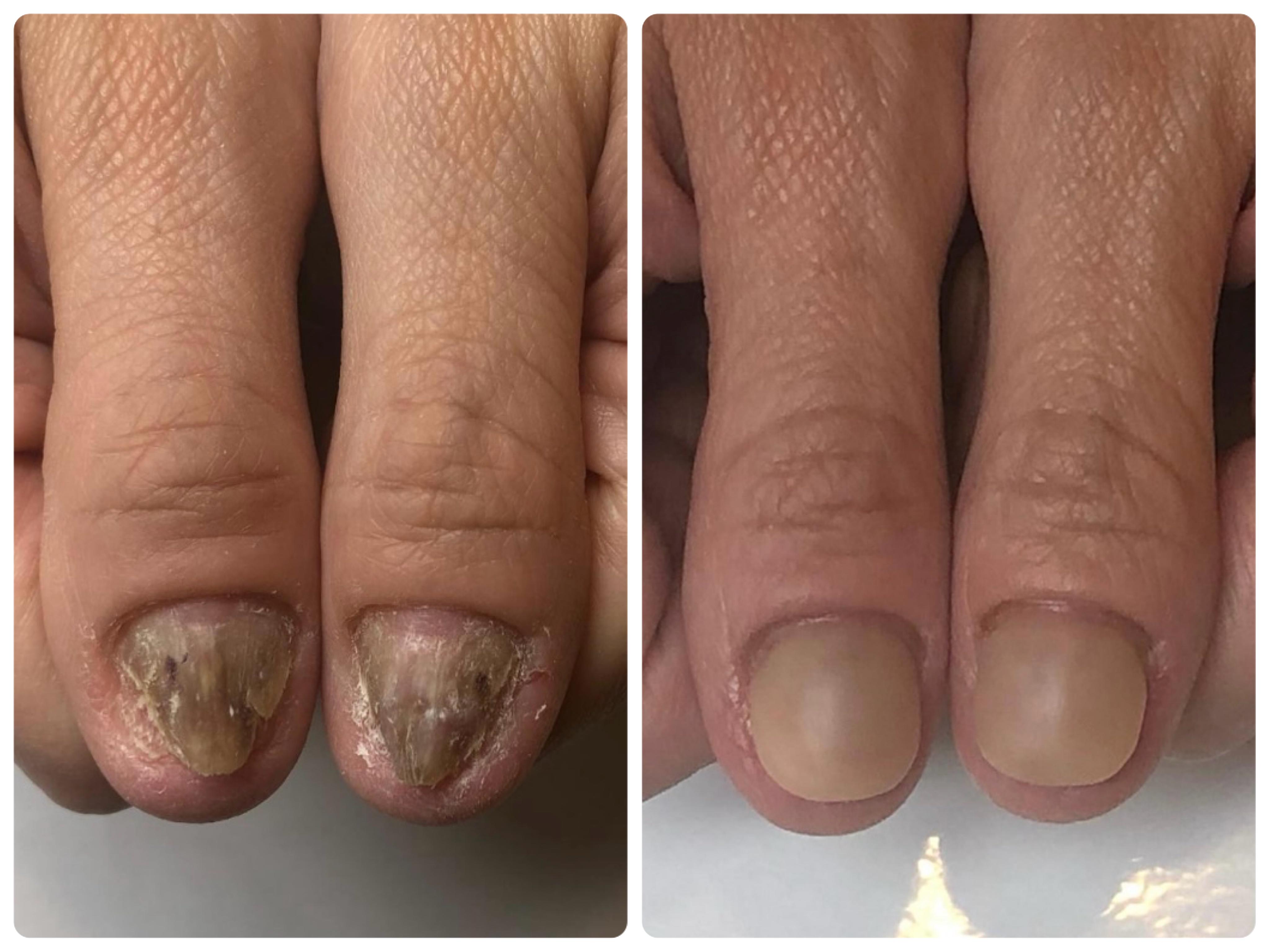 仙台市若林区リプロネイル式深爪矯正専門ネイルサロン デイジー事例写真